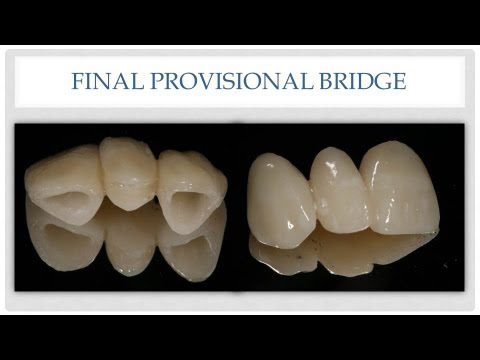 The Esthetic Provisional Bridge