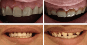 Before and After Dr Duane H Beers