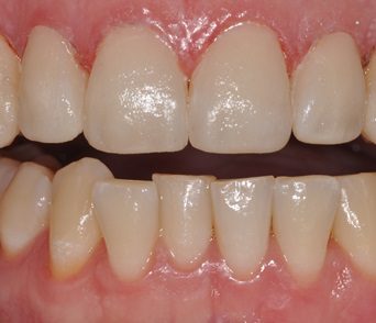 Direct Composite Veneers on a Class IV Restoration