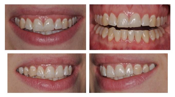 Direct Composite Restorations