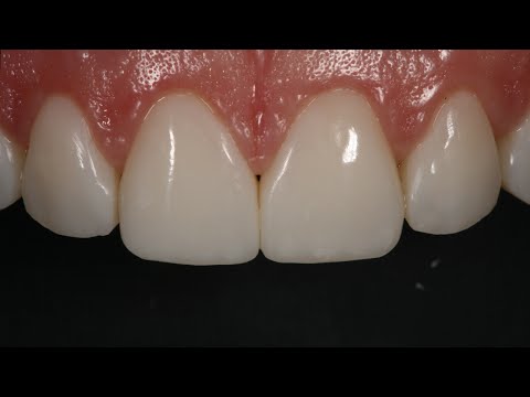 Resin Veneering and Diastema Closure