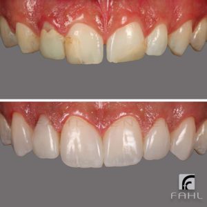 Newton Fahl, Jr. Before and After Anteriors