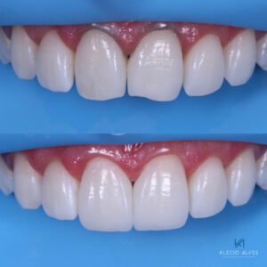 Dr. Kelcio de Alves Before and After image using Renamel Microfill Opalite color.