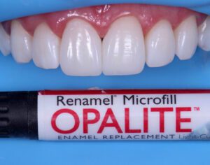 Dr. Klecio de Alves uses Reamel Opalite Microfill to recreate the tooth's opalescence.