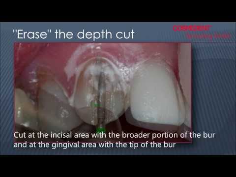 Composite Veneer Preparation