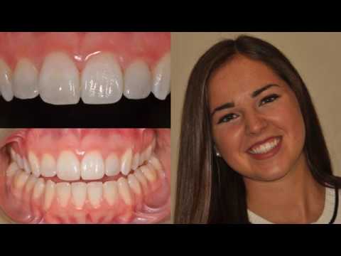 Instant Ortho With Composite