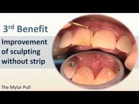 Achieving Great Contours and Contacts Using the Mylar Pull Technique