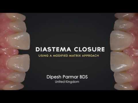 Diastema Closure Perfection – Using a modified matrix approach