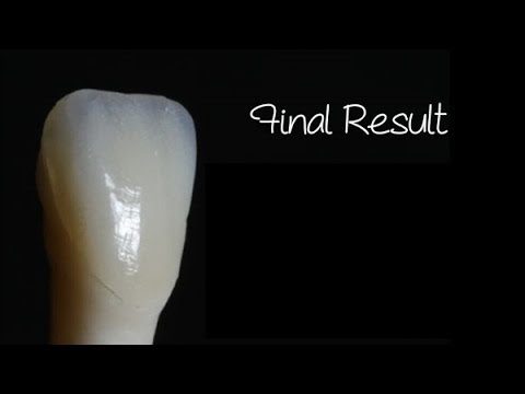 Composite Veneer by Dr. Bob Margeas