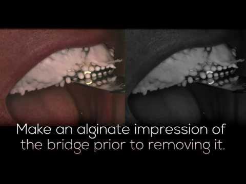 Temporary Dental Bridge