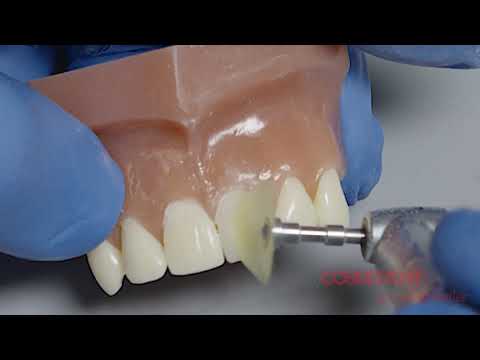 How to Achieve a High Luster on your Composite Restorations