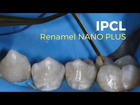 Use IPCL to restore minimally-invasive cavity preparations