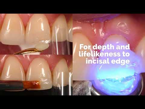 Chip Repair with Composite Resin by Dr. Newton Fahl