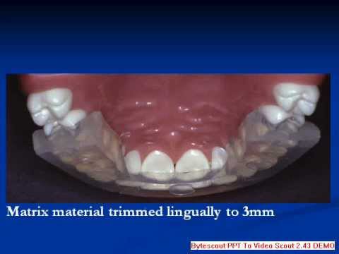 Rapid Simplified Veneer Provisionals (RSVP)