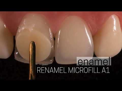 Class IV Composite Restoration – Amanda Seay, DDS