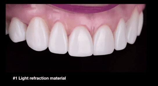 restoration-and-veneers-with-mininal-enamel-loss-using-composites-and-ceramics.png