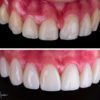 Javier Quiros Before and After Composite Veneers