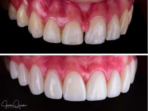 Javier Quiros Before and After Composite Veneers