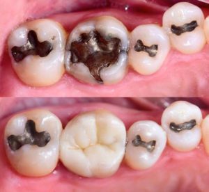 Javier Quiros Posterior Restoration