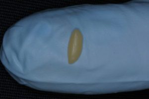 Step 10 Class III Restoration Dr Buddy Mopper Microfill A3 Rolled