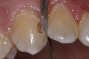 Clean the interproximal contact with Cosmedent’s FlexiDiamond Strip.