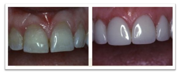 Restorative Technique – Color Change Veneer