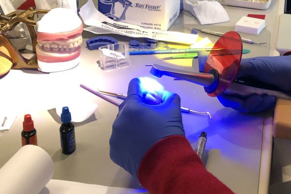 Klecio Alves Direct Composite Veneers: The Art of Creating Smiles