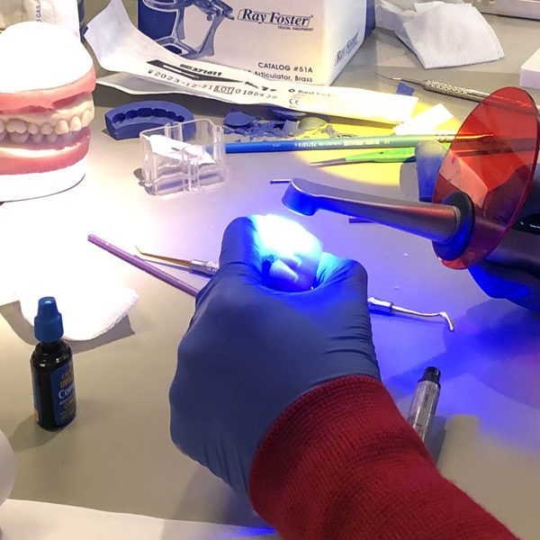 Klecio Alves Direct Composite Veneers: The Art of Creating Smiles