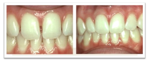 Restorative Technique – Diastema Closure