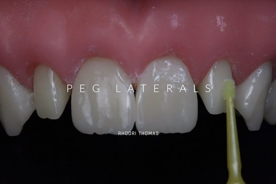 Peg Laterals – Lateral Incisor Bonding Guide
