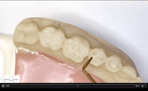 IP thin use being demonstrated for adhesive restoration of posterior teeth