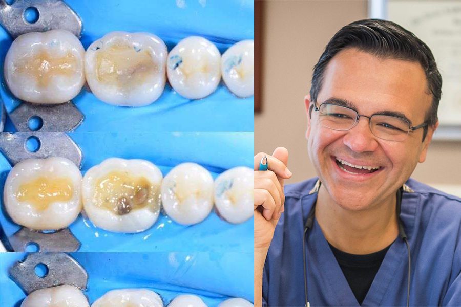 The Art and Science of Adhesive Posterior Restorations