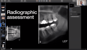 Radiographic assessment of left side of face jaw in need of posterior restorations