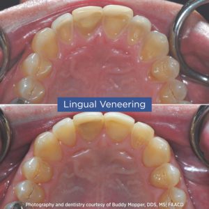 20221014 Webinar Mopper Before and After Lingual Veneering