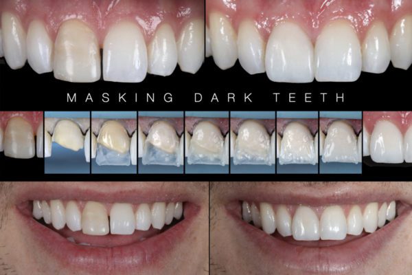 Masking a Dark Tooth with Rhodri Thomas