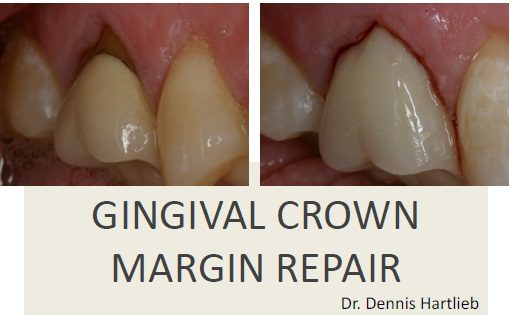 crown margin repair