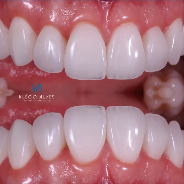 Live Webinar: Aesthetic and Functional Rehabilitation with Composite Resins - Image 4