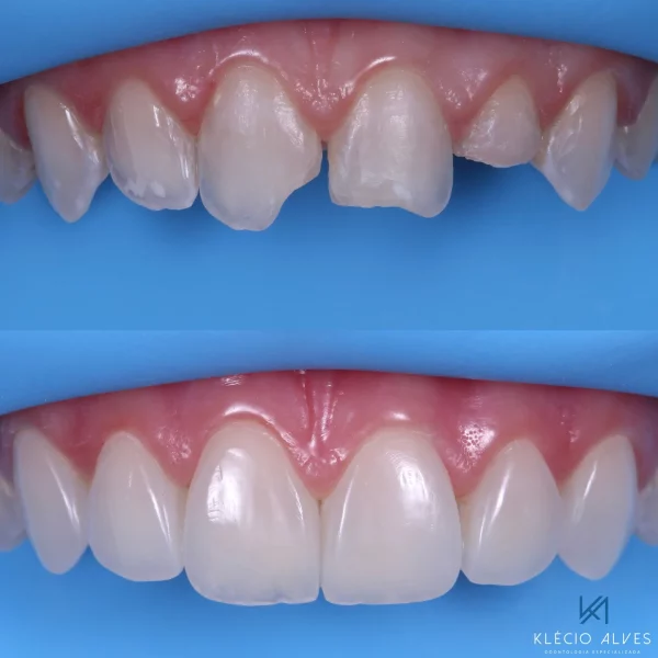 Live Webinar: Aesthetic and Functional Rehabilitation with Composite Resins - Image 3