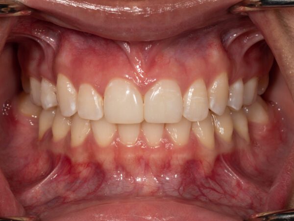 Live Webinar: Composites for Diastema Closure - Image 2