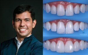 Aesthetic and Functional Rehabilitation with Composite Resins with Klécio de Andrade Alves, DDS, UFPE, SOEPE