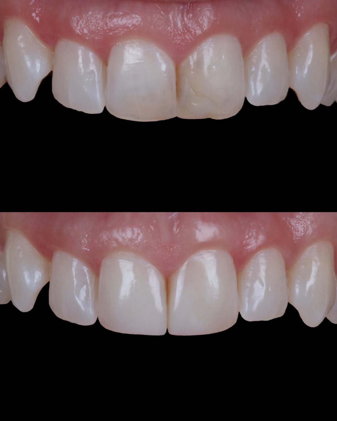 Rhodri Thomas Before and After Composite Restoration 1