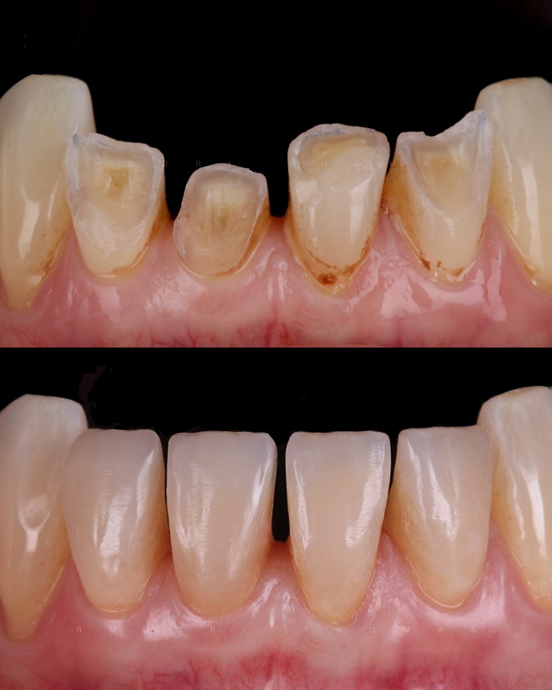 Rhodri Thomas Before and After Composite Restoration 4