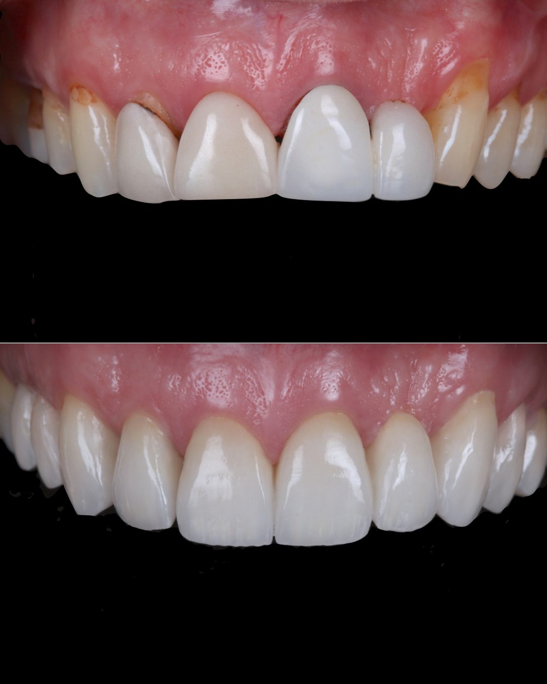 Rhodri Thomas Before and After Composite Restoration 2
