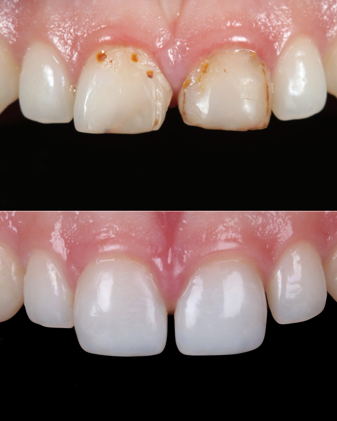 Rhodri Thomas Before and After Composite Restoration 3