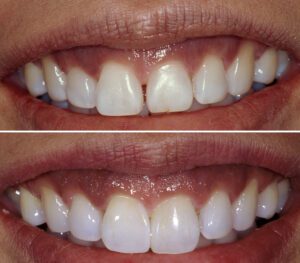 Brian LeSage, DDS, FAACD, Before and After Diastema Closure