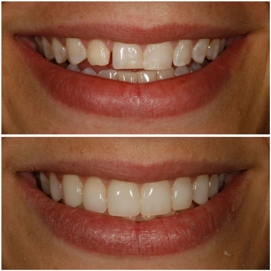 Dr. Corky Willhite Composite Before and After 3