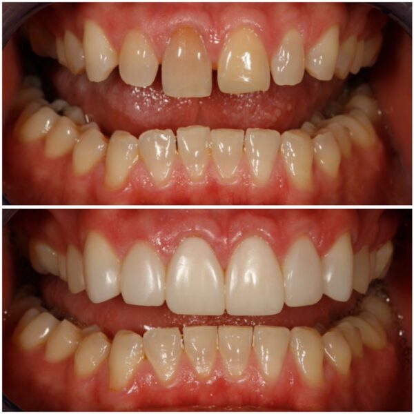 Dr. Corky Willhite Composite Before and After 2