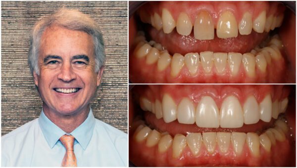 The Key to Successful Smile Makeovers Webinar with Dr. Corky Willhite