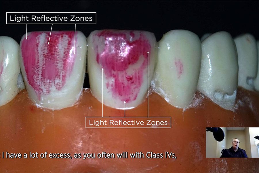 Using Articulating Paper to Determine Needed Texture on Your Composite Restoration