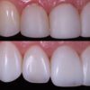 Cosmetic Dentist Dr. Kelcio Alves Before and After photo using Composite Resin